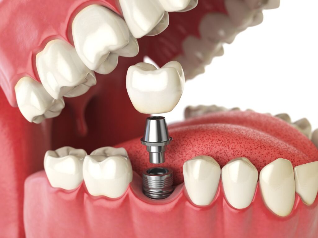 زراعة الأسنان مقابل الجسور_ مميزات وعيوب كل خيار Dental Implants vs. Bridges_ Advantages and Disadvantages of Each Option