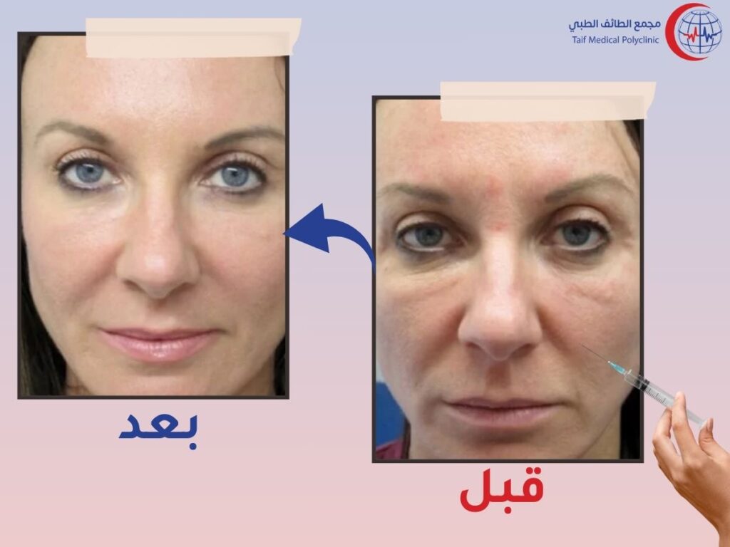 ابرة بروفايلو: الحل الأمثل لنضارة البشرة بأفضل سعر في الرياض Profhilo needle: the perfect solution for skin freshness at the best price in Riyadh