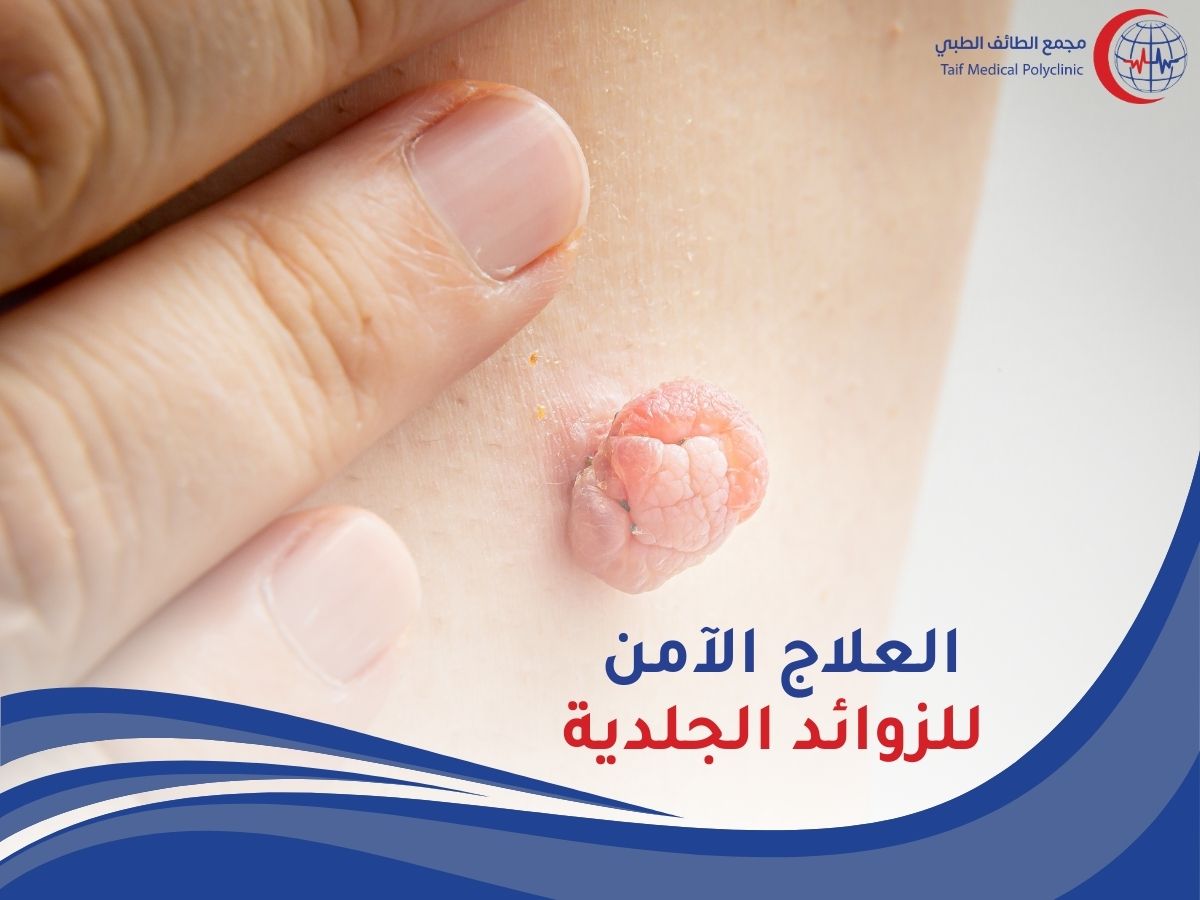 الزوائد الجلدية: هل تشكل خطراً وكيف يمكن إزالتها بطرق آمنة؟ Skin tags: Are they dangerous and how can they be removed safely?