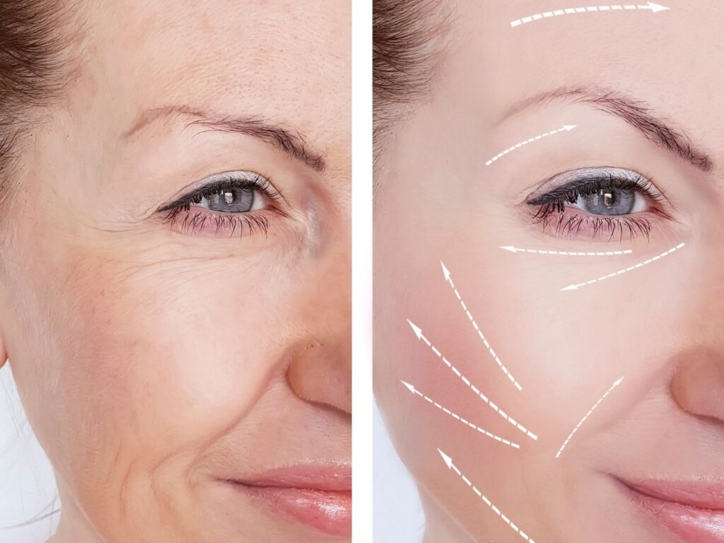 شد الوجه بالخيوط: الحل السحري لشد البشرة واستعادة الشباب بدون جراحة! Thread facelift: The magic solution to tighten the skin and restore youth without surgery!