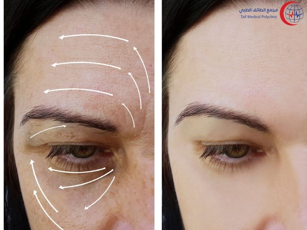 ما هي إبرة النضارة هايدروديلوكس وكيف تحسن مظهر بشرتك؟ What is HydroDeluxe and how does it improve the appearance of your skin?